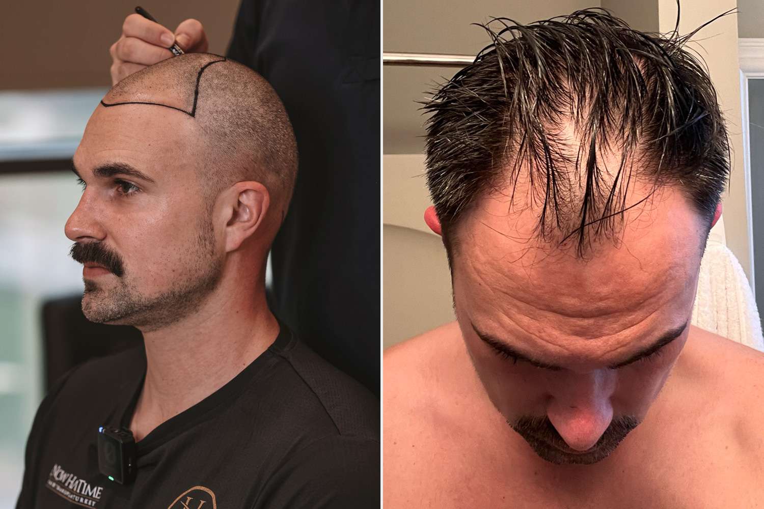 Discreet Men’s Hair Replacement NYC